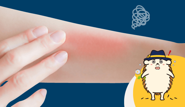 火傷やお肌トラブルは大丈夫?